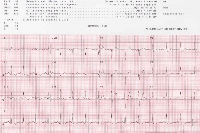 ekg1